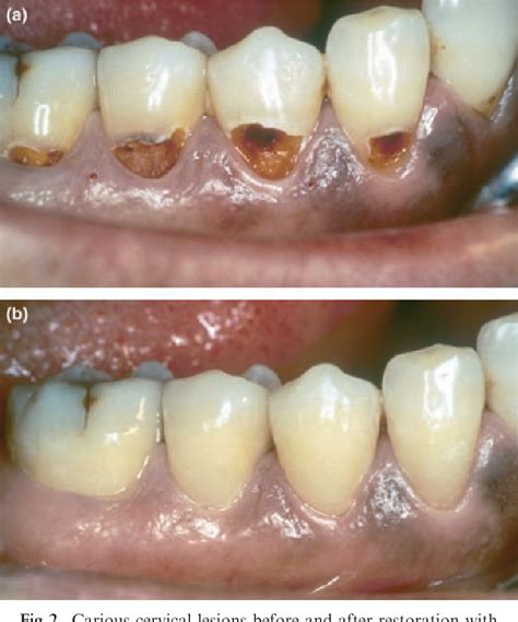 Figure From Glass Ionomer Cement Restorative Materials A Sticky