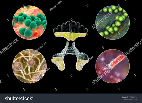 Anatomy Rhinosinusitis Microorganisms That Cause Sinusitis Stock