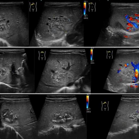 US Study Of The Liver Longitudinal And Transverse Scan Along The