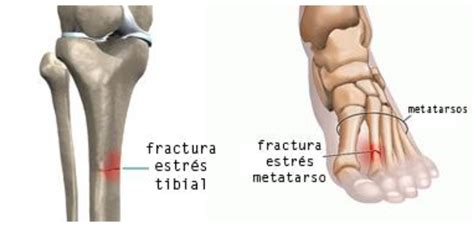 Todo lo que necesita saber si sospecha una fractura por estrés en el