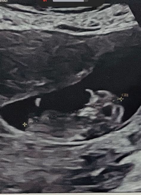 Any Guesses On The Gender Week Ultrasound Nub Theory Nub