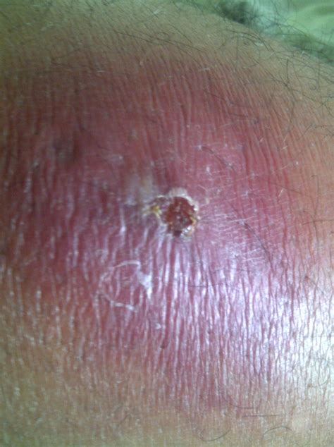 Celulitis Infecciosa Síntomas Diagnostico Prevención y Tratamientos