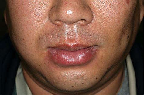 Figure 2 From Improvement Of Cheilitis Granulomatosa After Dental