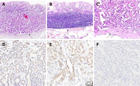 Multiple Gastric Adenocarcinoma Of Fundic Gland Type A Case Report