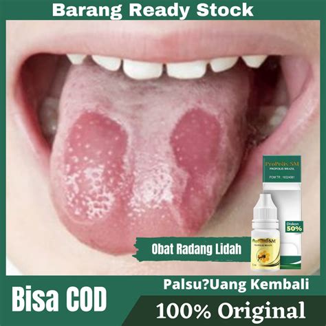 Jual Obat Radang Lidahlidah Terasa Pahitluka Di Lidahsariawan Di