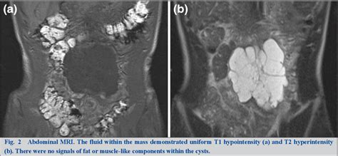 Figure 2 From A Case Of Retroperitoneal Benign Multicystic Peritoneal