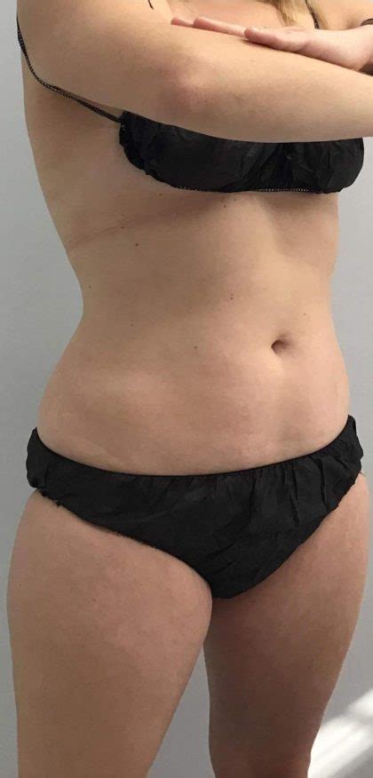 Patient 16397 Body Contouring Before And After Photos Santa Monica Plastic Surgery Gallery