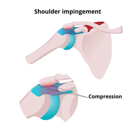 Subacromial Impingement Exercises Museosdelima