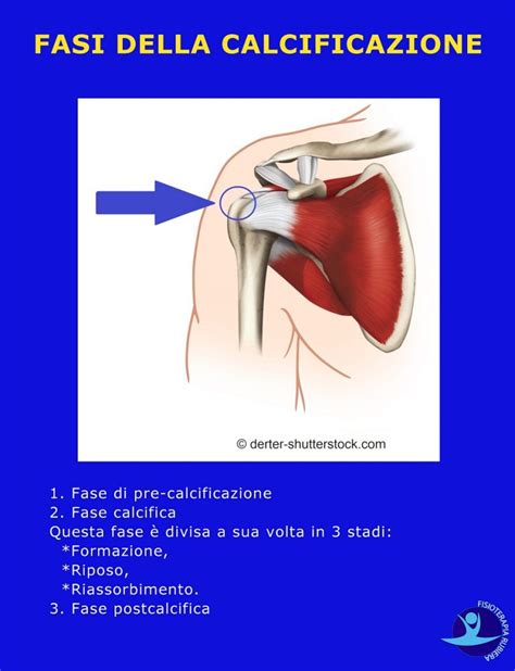 Calcificazione Alla Spalla Le Cause I Sintomi E La Fisioterapia