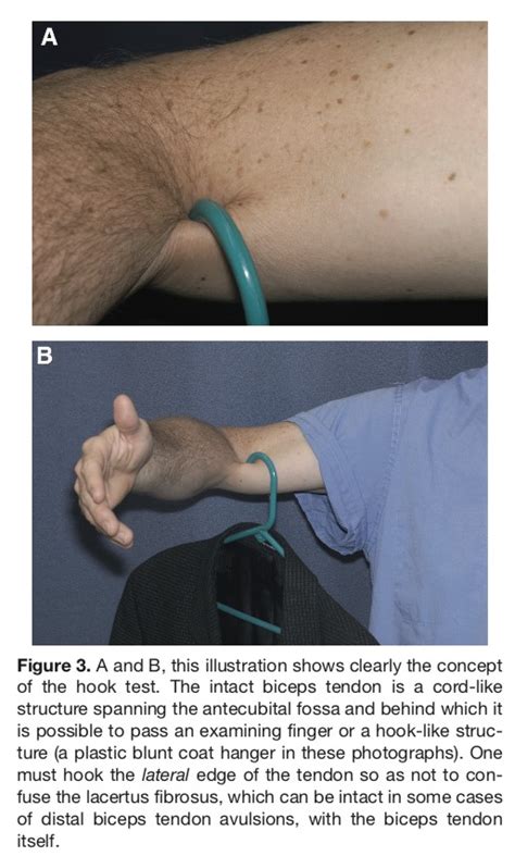 Distal Biceps Rupture Orthosports