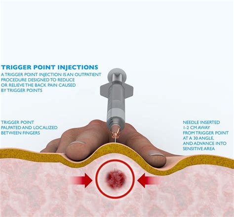 Trigger Point Injections - Dr. Sam | Personal Injury and Trauma Psychiatry Doctor In San Antonio