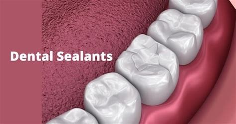 What Are Dental Sealants? | Mid Cities Dental