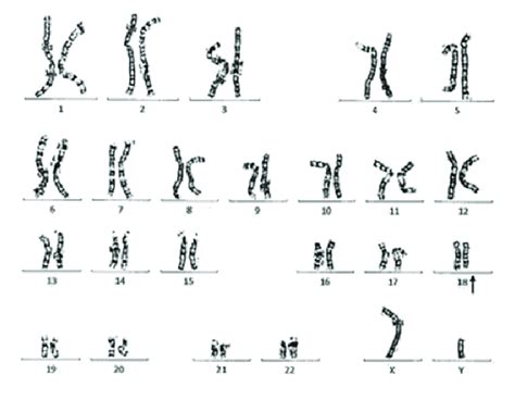 Karyotype Showing Chromosome 18q Deletion Download Scientific Diagram