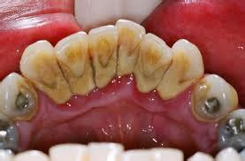 What is Tartar (Calculus) Buildup? - Wake Dental Wellness : Dentist in ...