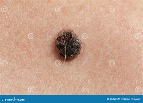 Melanoma Cell Visualization Royalty Free Stock Photography