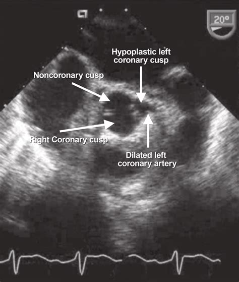 Preoperative Transesophageal Echocardiogram Short Axis View Shows A Download Scientific