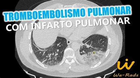 Tromboembolismo Pulmonar Tep Na Angiotomografia De T Rax Infarto