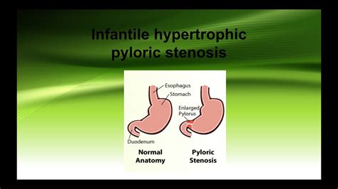 Infantile Hypertrophic Pyloric Stenosis Youtube