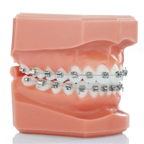 Experience Metal Mbt Mandibular Gc Orthodontics Inc