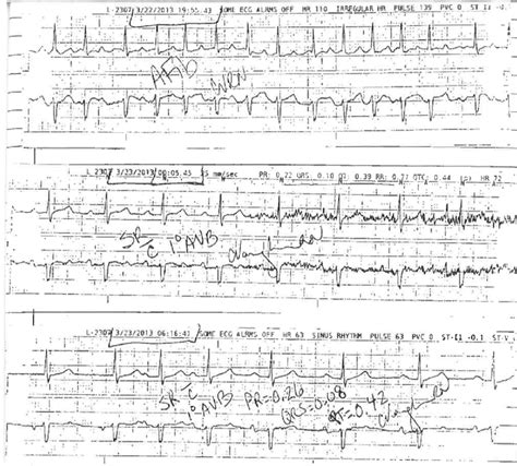 Rhythm strips showing conversion from atrial fibrillation to normal ...