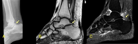 Posterior Ankle Impingement Syndrome Reumatología Clínica