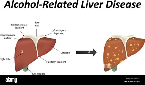 Alcohol Related Liver Disease Stock Photo - Alamy