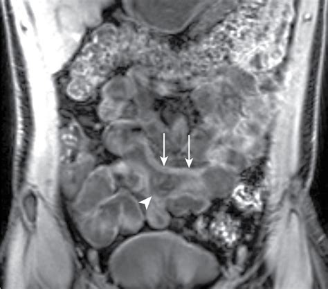 Bowel Wall Anatomy