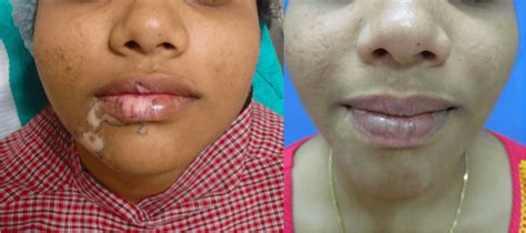 Leucoderma [vitiligo] Causes Symptoms And Treatment