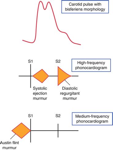 Aortic Regurgitation | Thoracic Key