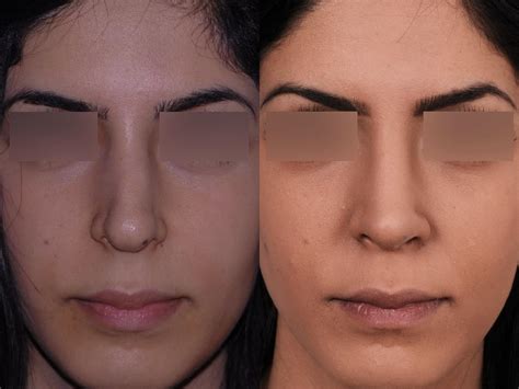 Rhinoplastie Avant Apr S Photos Et Exemples De Nez Refaits