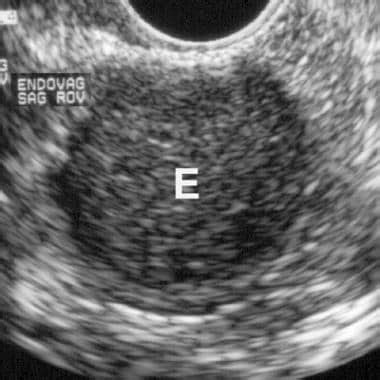 Endometriosis Ultrasound