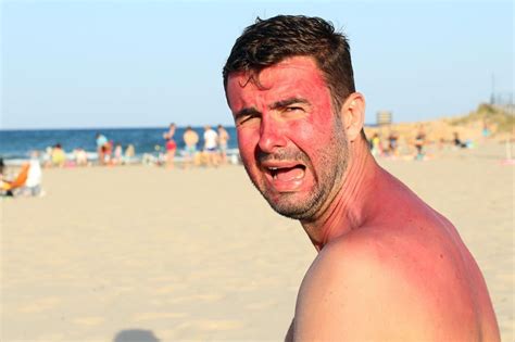 Coup De Soleil Comment éviter Les Excès De Bronzage