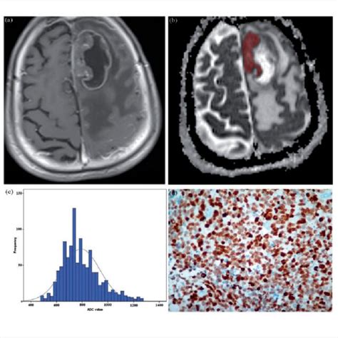 Representative case of brain metastasis (BM) from small-cell lung ...