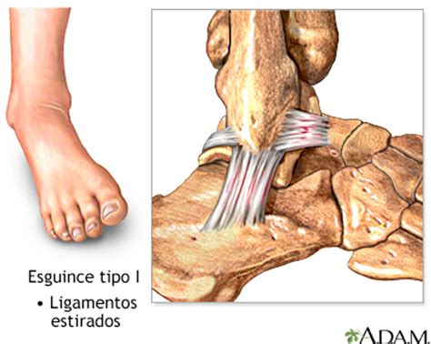 Lesión De Los Ligamentos Externos Del Tobillo Resport Clinic