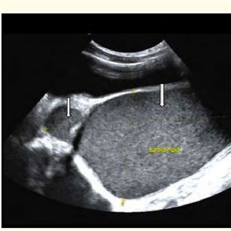 Ultrasound Dilated Vagina And Cervix Arrows Download Scientific Diagram