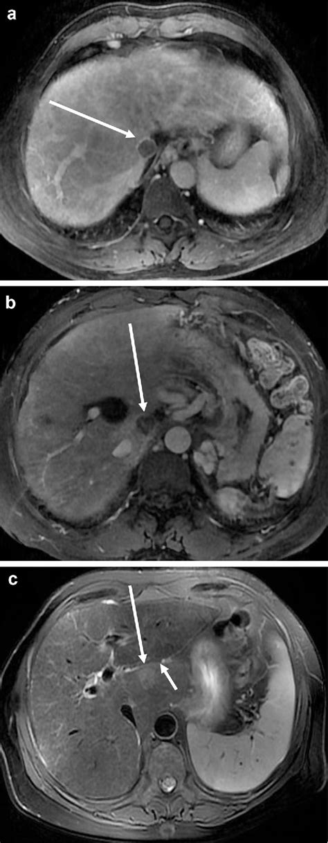 Figure 1 From Ultrasound Guided Percutaneous Microwave Ablation For Hepatocellular Carcinoma In