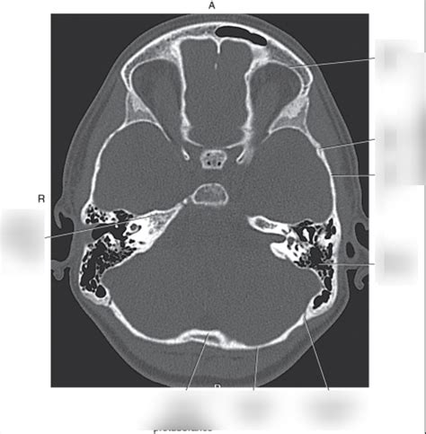 Axial Ct Head Diagram Quizlet