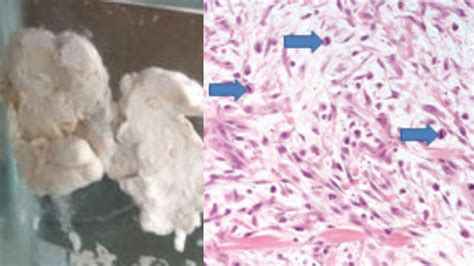 Soft Tissue Tumors Causes Classification Morphology NotesMed NotesMed