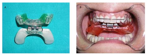 Jpm Free Full Text Radica Splint Therapy In The Management Of