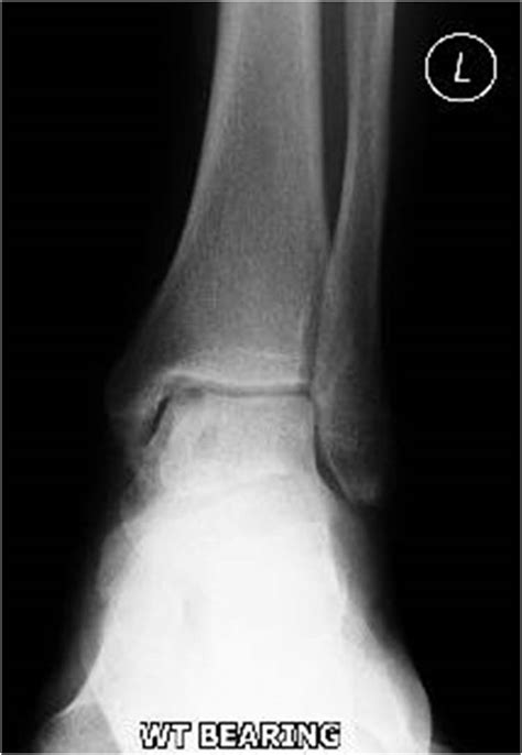 Talar dome lesions | The Foot and Ankle Online Journal