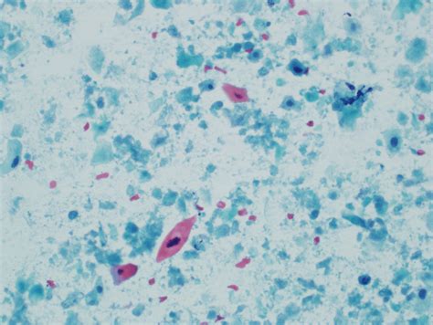 Fine‐needle Aspiration Fna Biopsy Of The Lymph Node Showed Necrotic