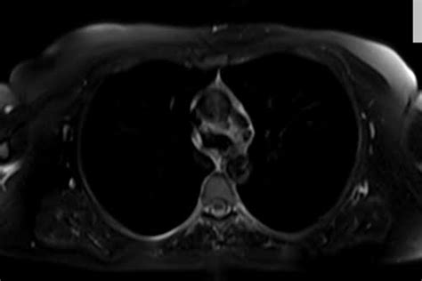 Mri T2 Fat Saturated Sequence Physics And Image Appearance