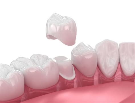 How a Dental Crown Can Help Save Your Tooth - BioDental Care Tijuana