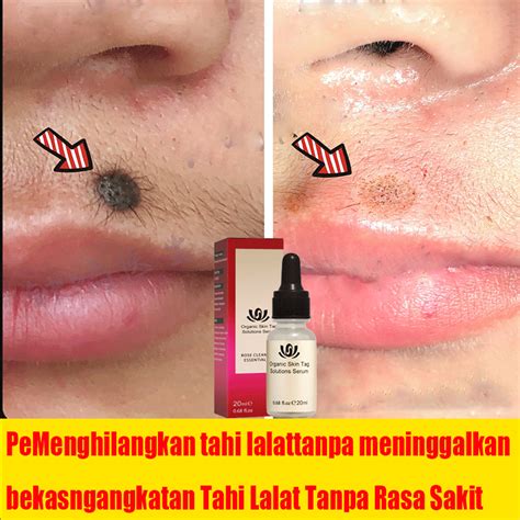 Jual Penghilang Kutil Di Wajah Krim Penghilang Tahi Lalat Alat