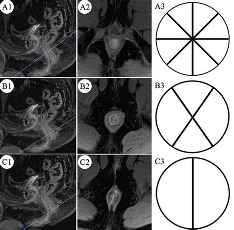 In The Early Arterial Phase Of Dynamic Contrast Enhanced Fat Saturated