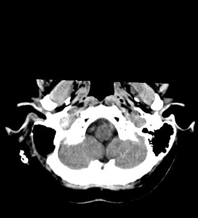 Internal Jugular Vein Thrombosis Radiology Case Radiopaedia Org