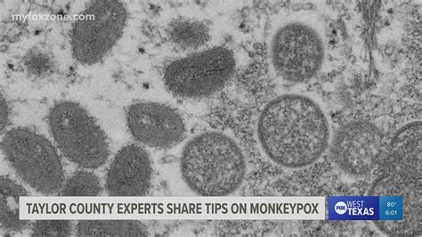 After Taylor County Confirms First Monkeypox Case Health Experts Give