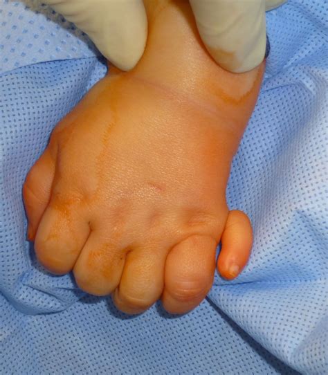 Extra Digits Congenital Hand And Arm Differences