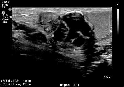 Papillary Cystadenoma Of The Epididymis Image