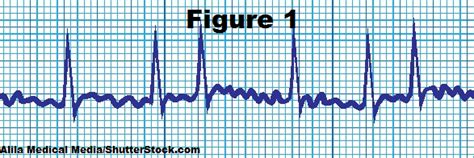 EKG Rhythm Practice Quiz for Atrial Fibrillation & Atrial Flutter